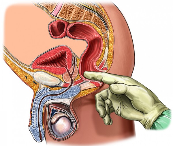 Prostate Cancer Diagnosis And Stages Grace Prostate Cancer Centre